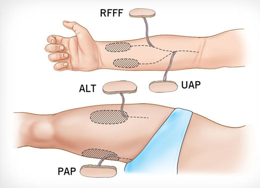 Microvascular Free Flap Reconstruction