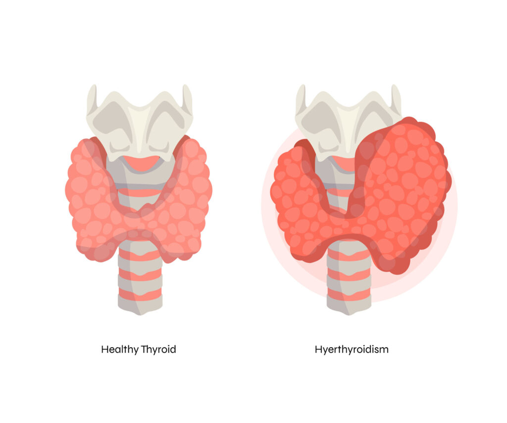 Thyroid Nodule Treatment in Hyderabad